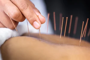 What to Expect at Your First Acupuncture Treatment in Austin at Austin Chiropractic & Acupuncture