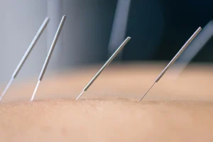 Acupuncture & Chiropractic Austin TX: 5 Proven Benefits